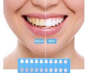 Kit de Blanqueamiento Dental